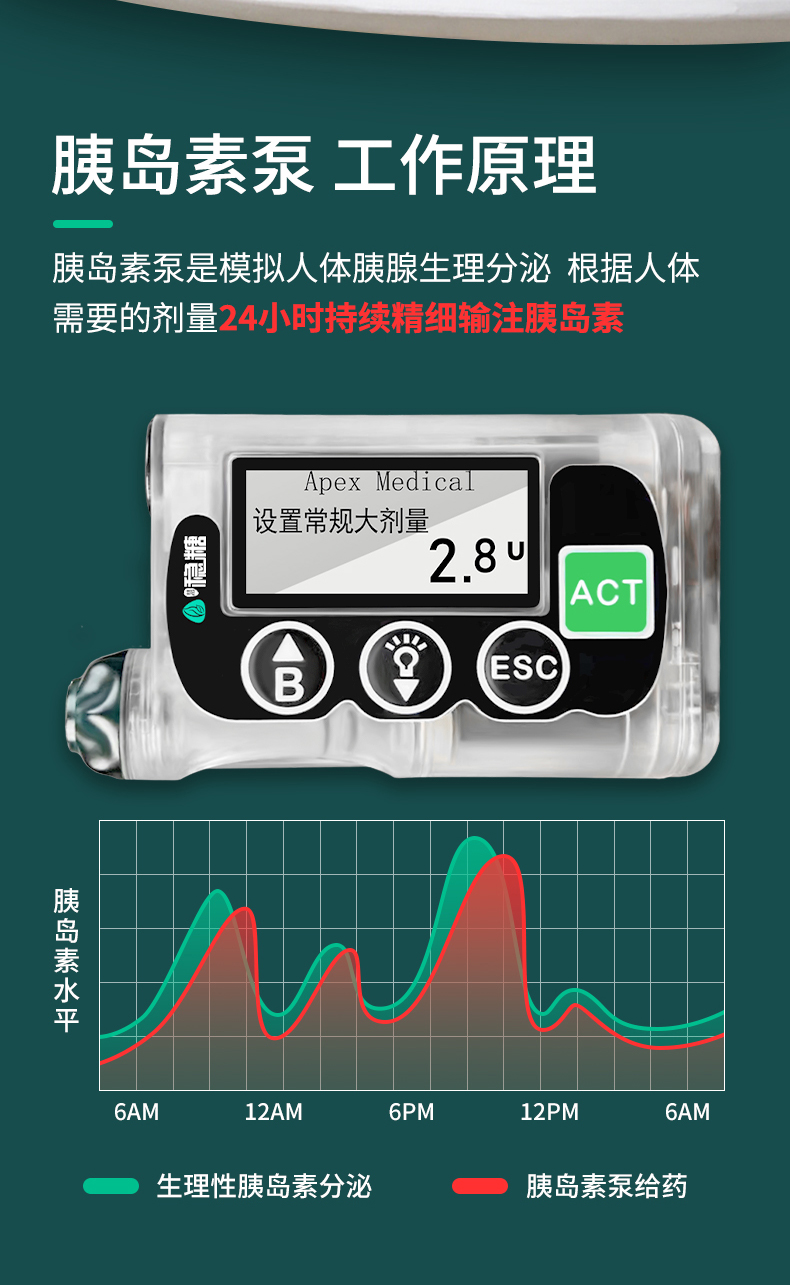 最新全自動胰島素泵，糖尿病管理的革命性進步，全自動胰島素泵，糖尿病管理的突破性革新