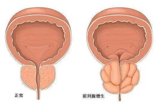 前列腺鈣化，一種常見的前列腺疾病及其相關(guān)知識解析，前列腺鈣化解析，常見疾病與相關(guān)知識探討