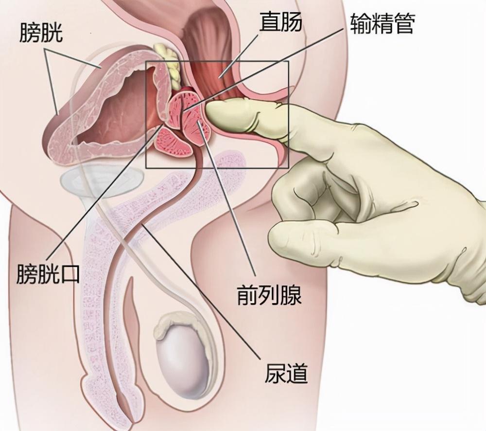 前列腺炎，重新認(rèn)識男性健康的誤區(qū)，重新認(rèn)識男性健康誤區(qū)，前列腺炎解析