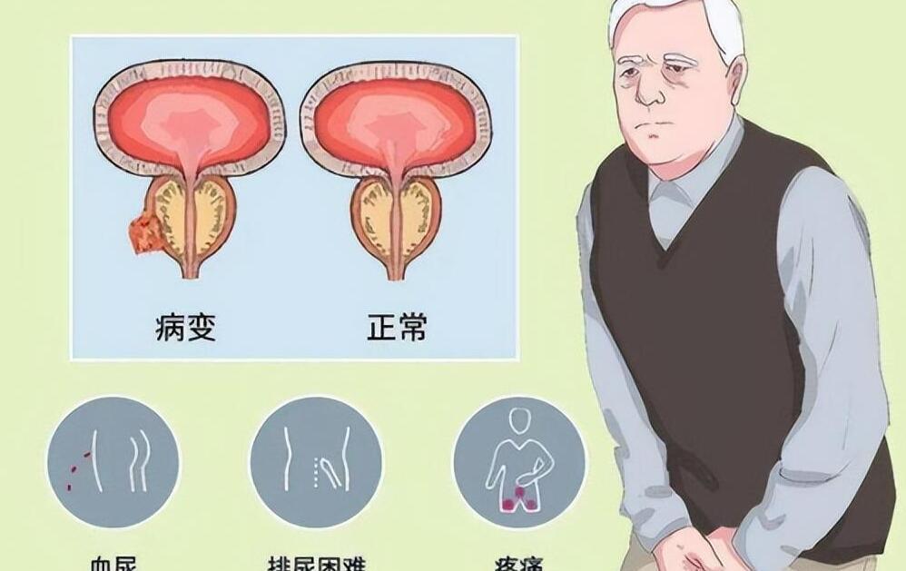 年輕人得了前列腺增大，理解、應(yīng)對與關(guān)注，年輕人前列腺增大，理解、應(yīng)對與關(guān)注的重要性