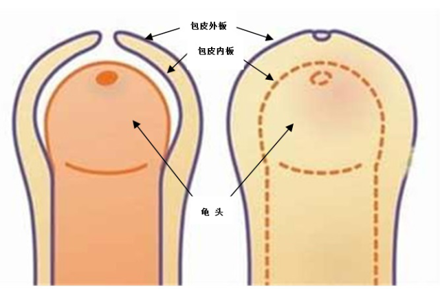 包莖及其相關(guān)圖片，了解、識別與處理，包莖詳解，圖片、識別、處理方法全攻略